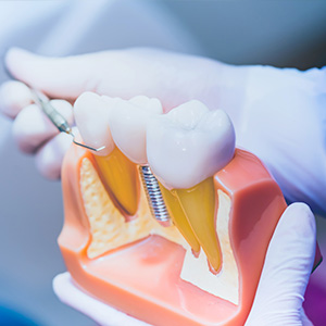 Dentistry for Life | Dental Cleanings, Dental Fillings and Root Canals